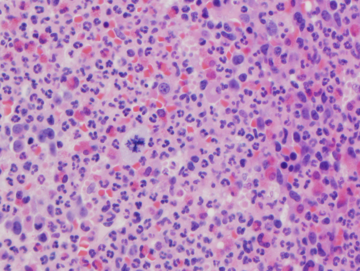 There was significant myeloid proliferation with focal slight increase in eosinophils.